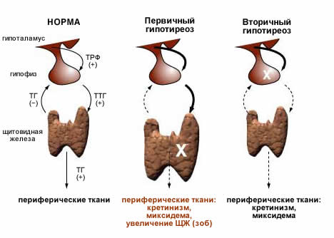 Основные виды гипотиреоза