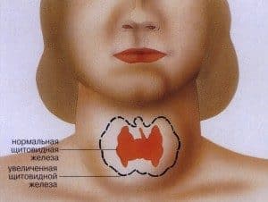 Пример увеличения щитовидки