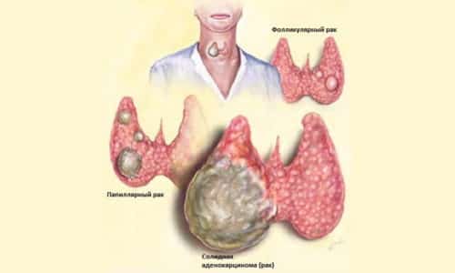 Фолликулярная опухоль щитовидной железы на ранних стадиях развития не имеет каких-либо симптомов, в 90% случаев она отличается доброкачественным характером, однако опасность ее состоит в склонности к злокачественному перерождению