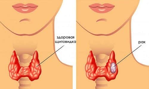 Тиреоидный рак щитовидной железы — это злокачественный процесс, при котором на фоне гормональных нарушений начинается перерождение парафолликулярных клеток