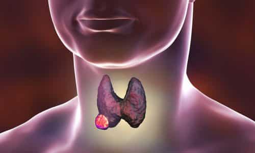 Развитие опухоли щитовидной железы также сопровождается увеличением органа в размерах, вследствие чего кадык сдавливается. Это и приводит к возникновению асимметрии и боли