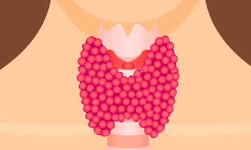Коллоидный зоб представляет собой патологическое увеличение щитовидной железы