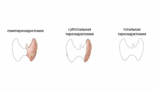 Причиной тиреотоксикоза могут являться операции на щитовидной железе, полное или частичное удаление органа
