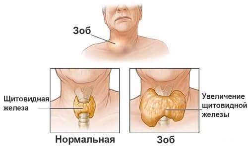 Зоб щитовидки - увеличение в размерах органа эндокринной системы, которое является не самостоятельным заболеванием, а симптомом других отклонений