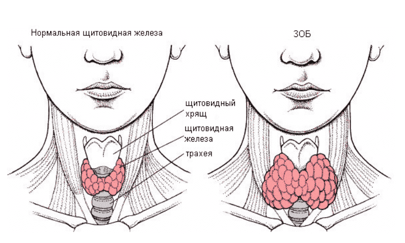 Зоб - болезнь щитовидной железы, встречающаяся как у женщин, так и у мужчин, это заболевание развивается из-за недостатка йода в организме