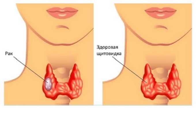 Один из причин возникновения узла в щитовидной железе развития доброкачественного или злокачественного новообразования