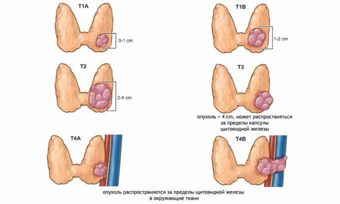 Злокачественная опухоль щитовидной железы может быть причиной повышения выработки АТ к тиреоглобулину