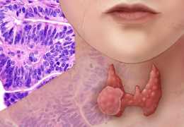 Прогноз при фолликулярной опухоли щитовидной железы