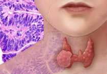 Что такое узловое образование правой доли щитовидной железы?