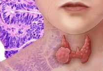 Как определить и лечить фолликулярную аденому щитовидной железы?