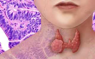 Как определить и лечить фолликулярную аденому щитовидной железы?