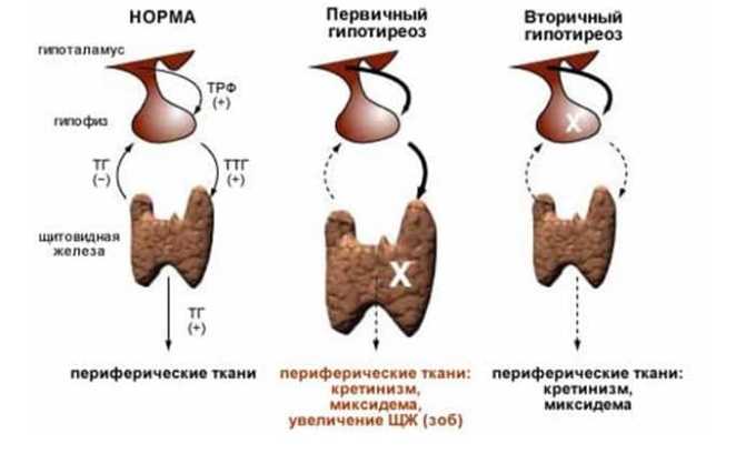 Развитие гипотиреоза приводит к уменьшению размеров щитовидной железы