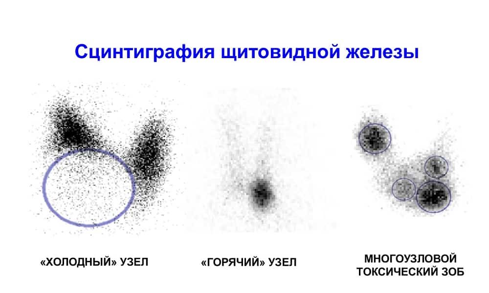 Сцинтиграфия щитовидной железы картинки