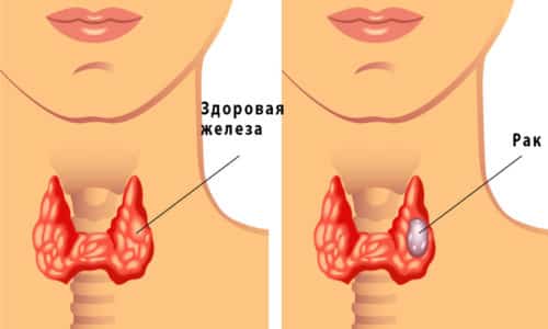 Щитовидка начинает душить человека при развитии рака щитовидной железы