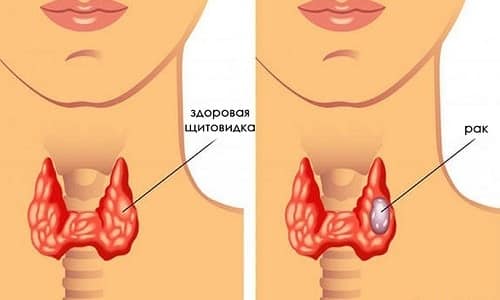 Анализ уровня гормона необходим при диагностировании рака щитовидной железы
