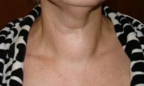 Спровоцировать кашель при щитовидке может фиброзный зоб